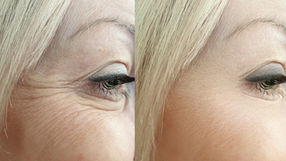 5 Miraculous Benefits of Dermal Fillers