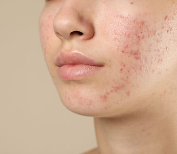 Acne Treatment.jpg