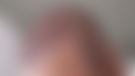 Conheça a técnica de transplante capilar FUE