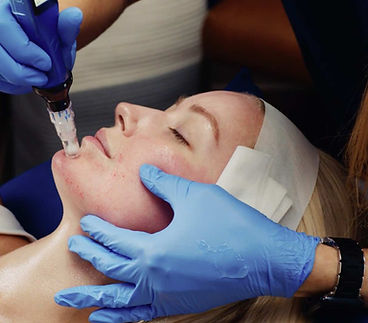 Skinpen-Treatment-SkinPen.jpg
