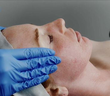 Skinpen-Treatment-After-Treatment.jpg