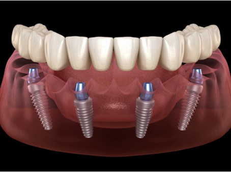 What is the cost of a dental implant?