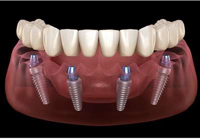 Fixed Full Arch IMplants.png