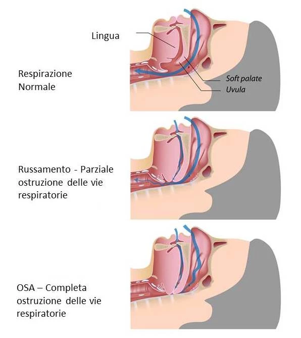OSA-Apnea-ostruttiva-del-sonno-2.webp