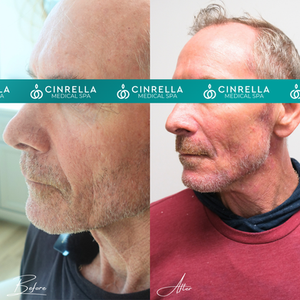 Fotona 4D: Tighter Skin, Sharper Jawline