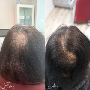 Hair Restoration