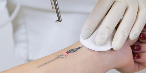 Tattoo removal.png