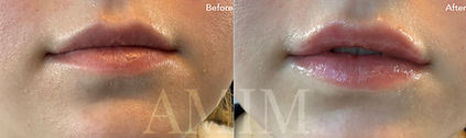 AMIM lip filler before and after