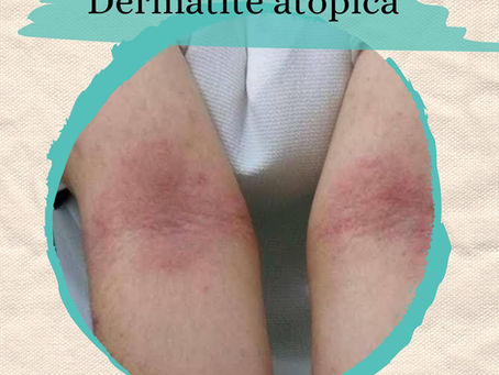 Dermatite Atópica