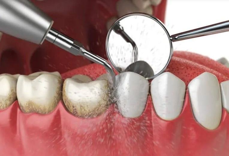 Teeth-Cleaning-Dubai
