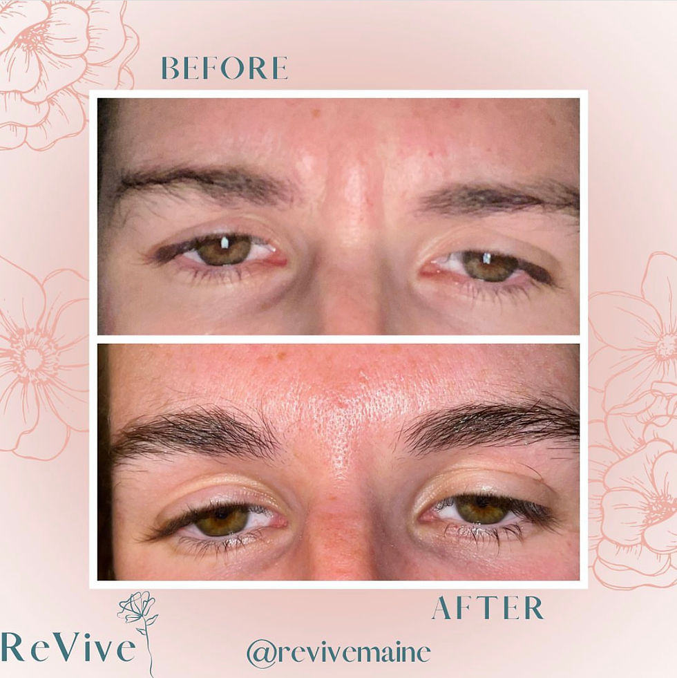 Frown lines before/ after