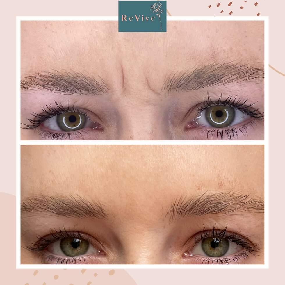 Frown Lines Before/ After