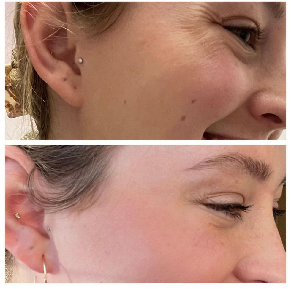 Crow's feet Before/ After