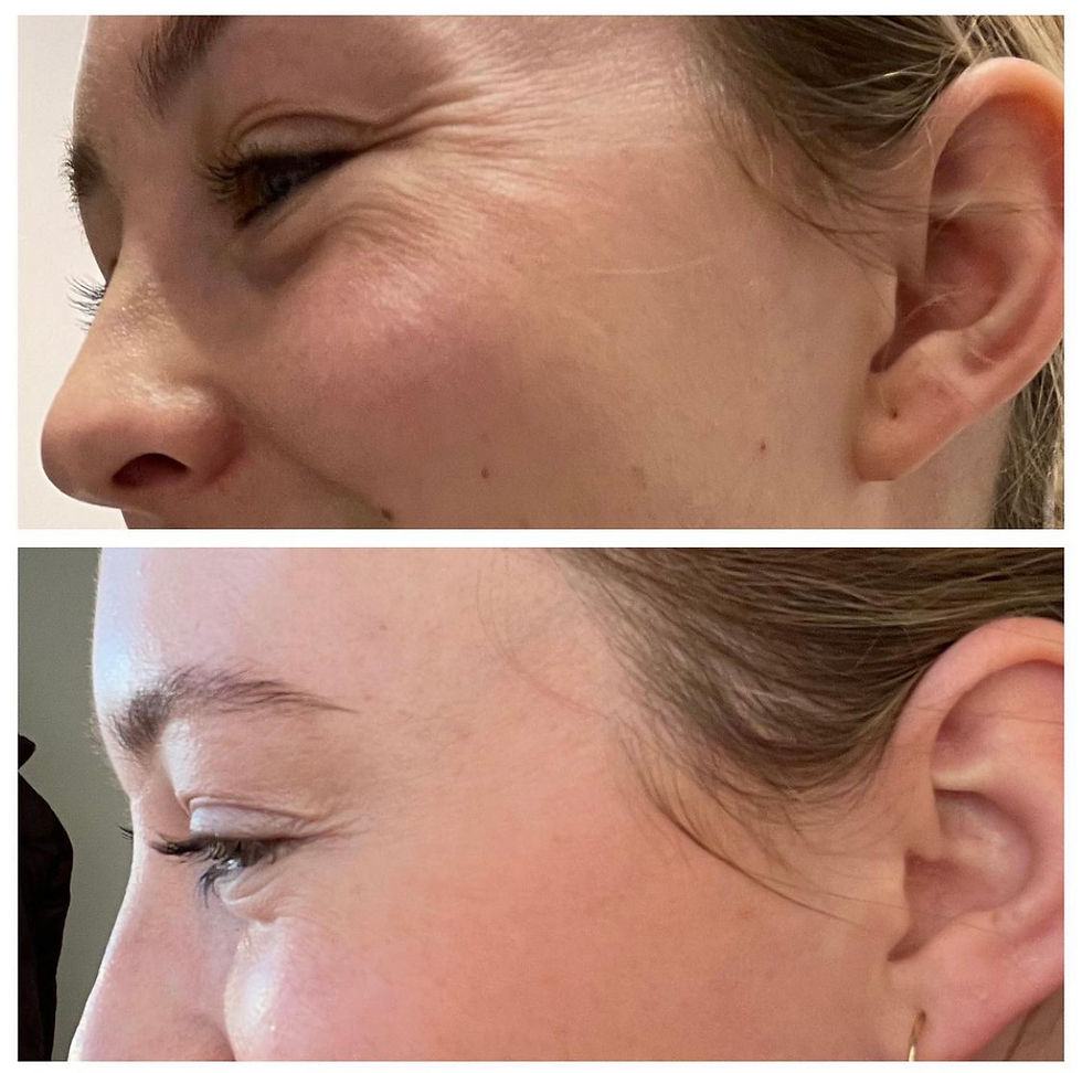 Crow's feet before/ after