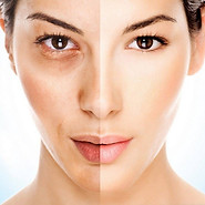melasma.jpg