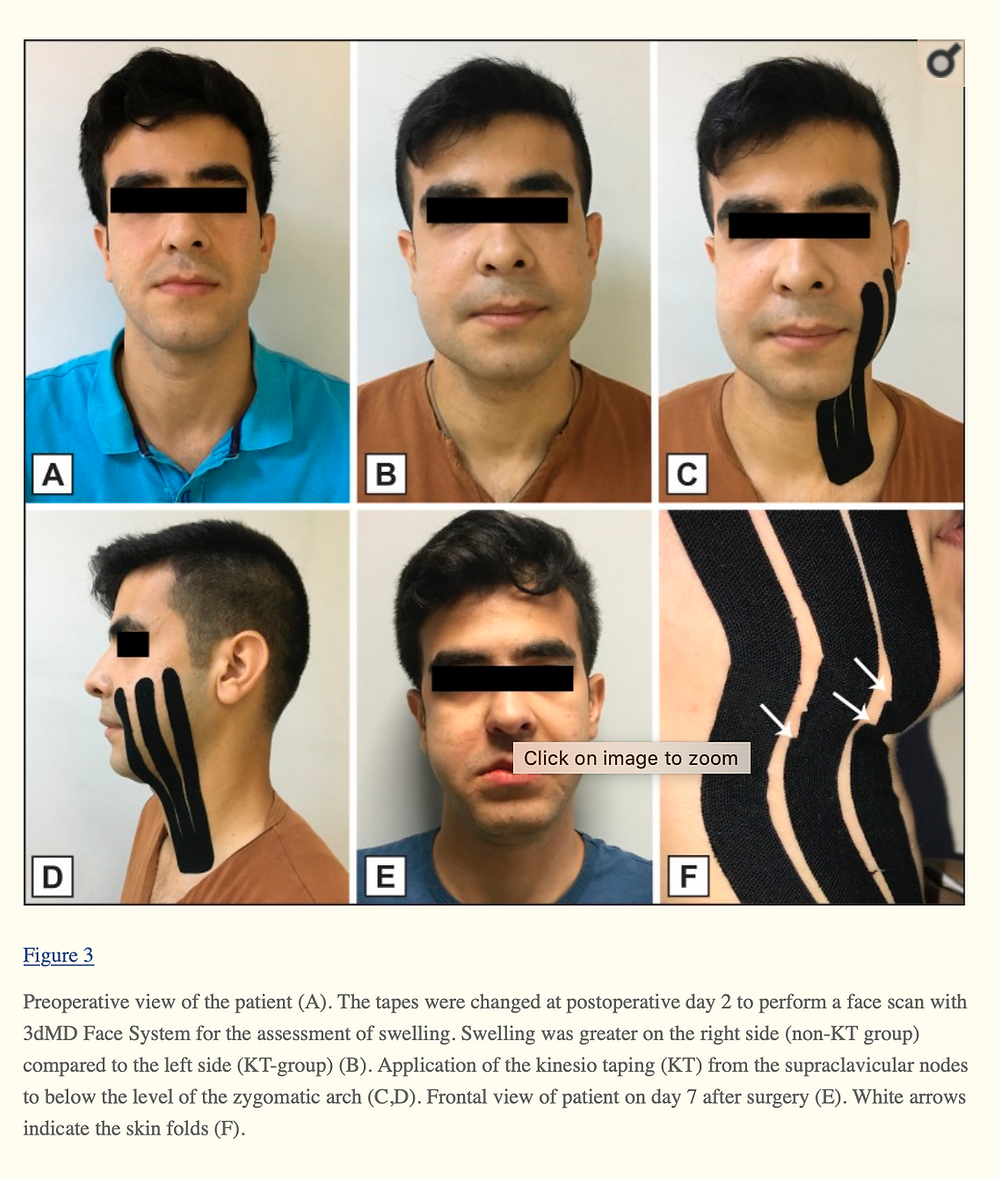 Compelling Evidence That Kinesiology Tape Can Reduce Swelling And