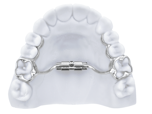 Palate Expander on 3D printed model of teeth