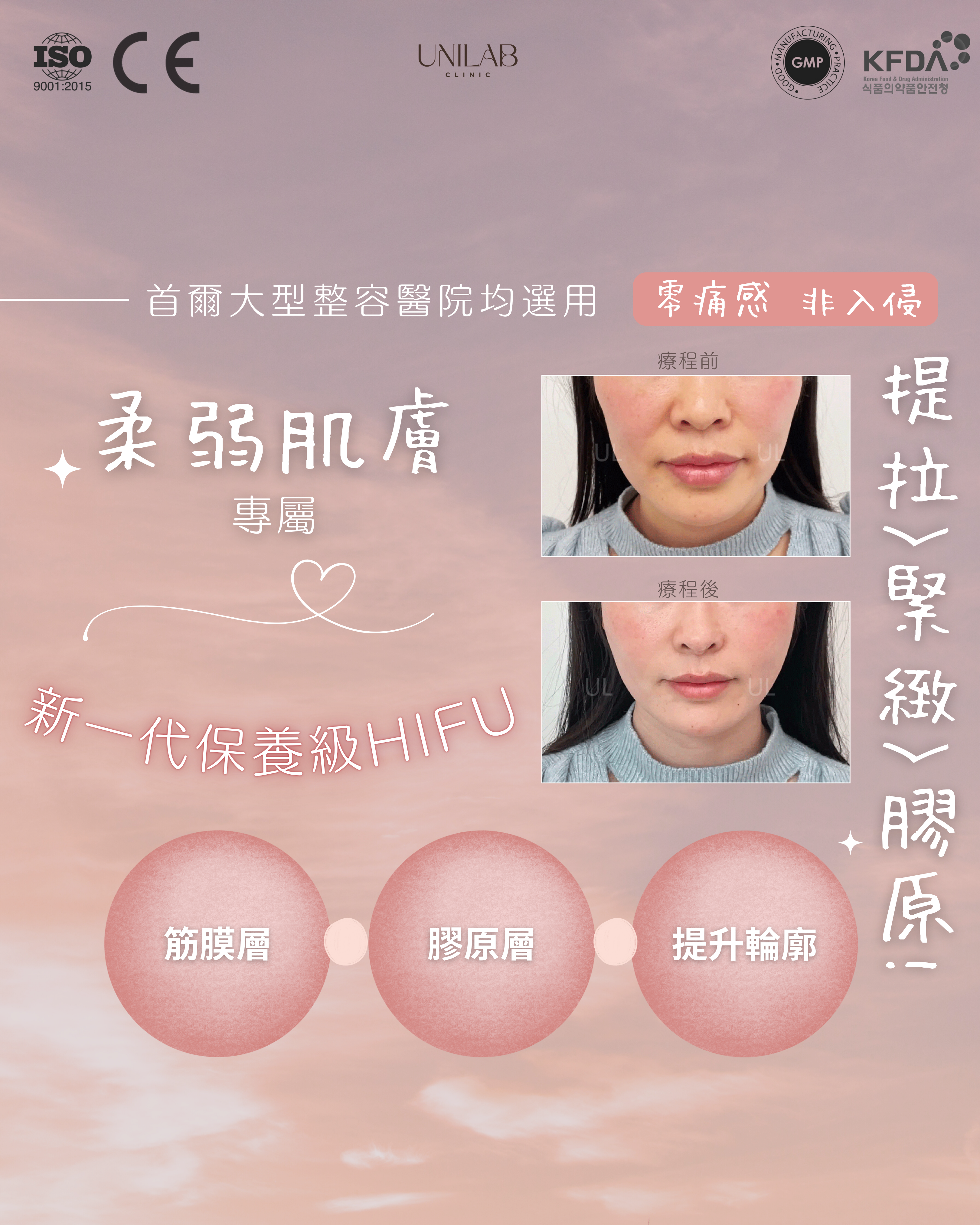 韓國 Face Lift HIFU 提升緊致療程