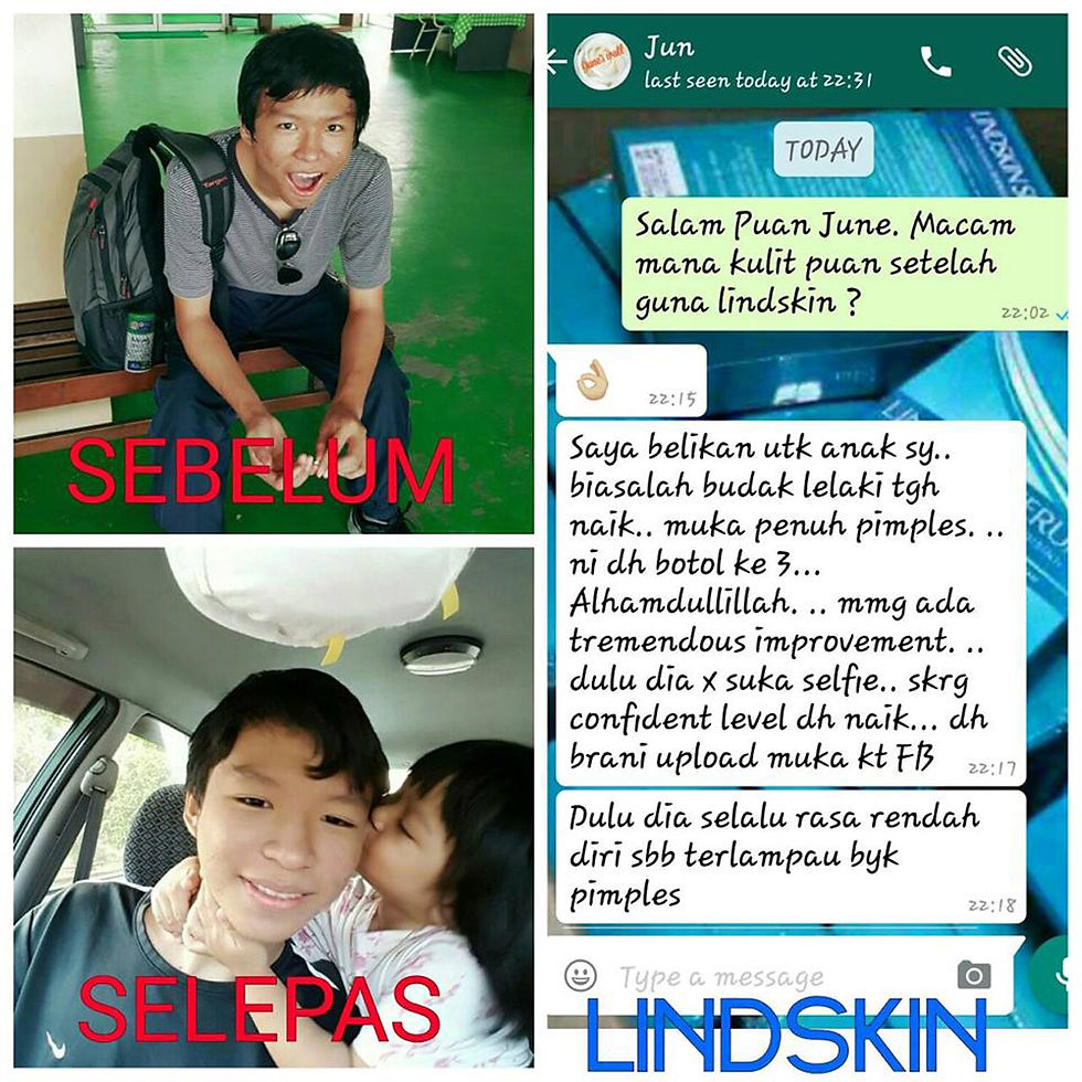 Cara mudah menghilangkan jerawat