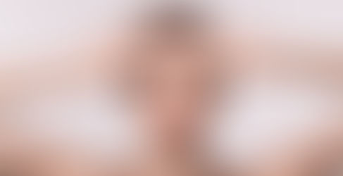 Filler ammi – Bí quyết trẻ hóa khuôn mặt tức thì