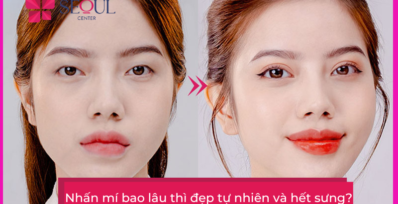Nhan mi mat bao lau thi lanh? Qua trinh hoi phuc sau nhan mi