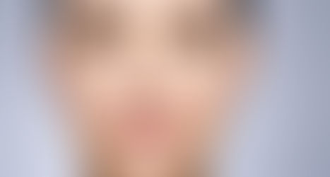 Khi nao nen cat mi lan 2? Nhung luu y giup so huu doi mat dep sau cat mi?