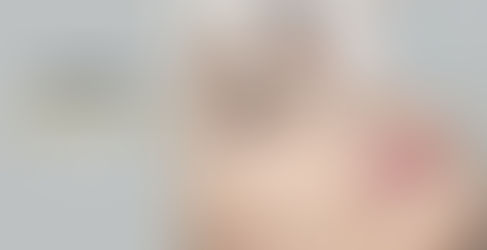 Nâng mũi bằng chỉ collagen kéo dài trong bao lâu?