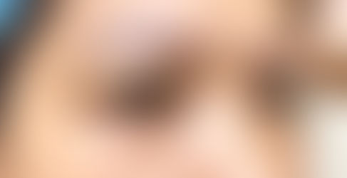 [Trả lời] Nâng cung chân mày có đau không?