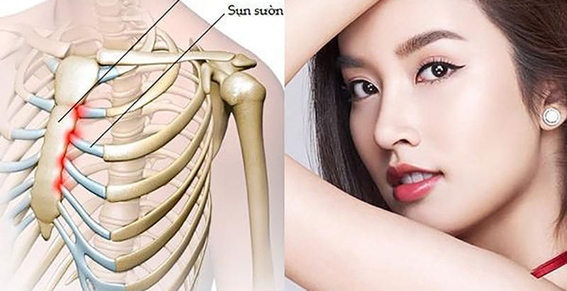 Nang mui cau truc sun suon co hieu qua khong?