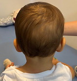 Bebê após o tratamento de torcicolo congênito
