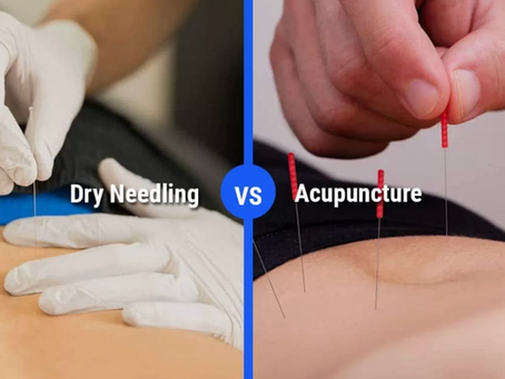 Dry Needling vs Acupuncture, What Is the Difference in Texas?