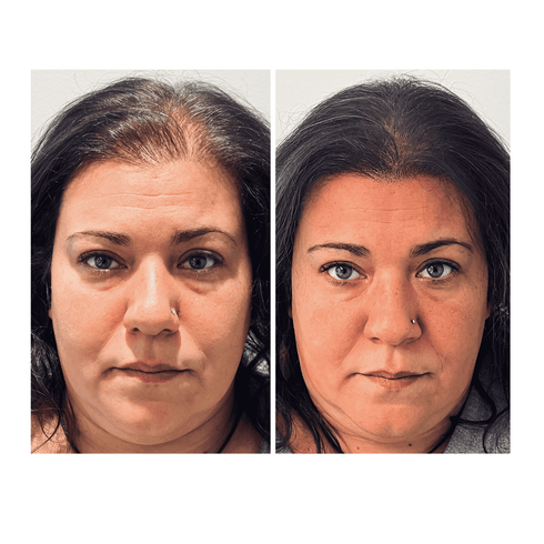 Micropigmentation capillaire sur femme avec cheveux clairsemés avec Hair tattoo by Hugues à Bruxelles.