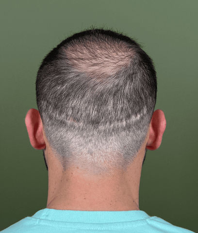 Masquer cicatrice greffe cheveux à à Bruxelles en Belgique avec Hair tattoo by Hugues.