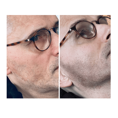 Résultat super naturel de Tricopigmentation de la barbe à Bruxelles chez Hair tattoo by Hugues.