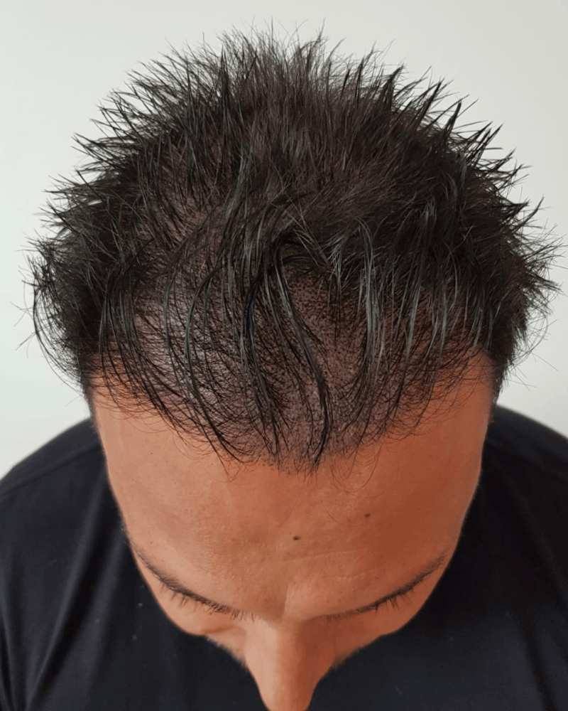 Tricopigmentation cheveux clairsemés homme à Bruxelles Belgique