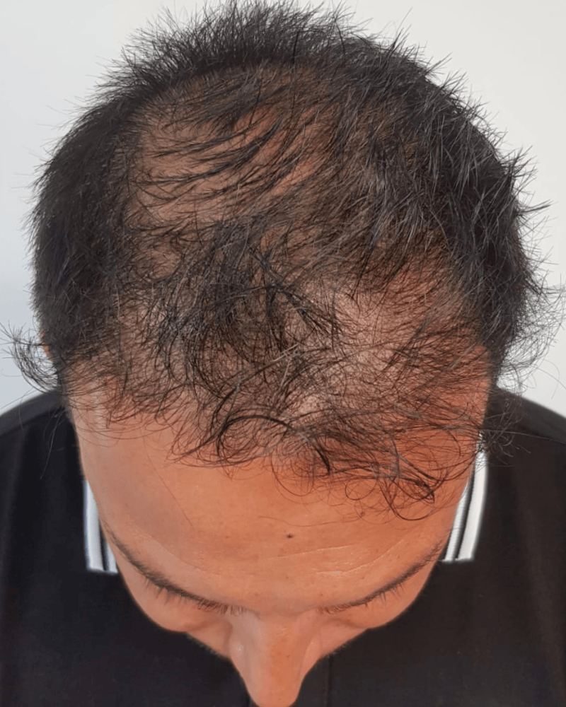 Tricopigmentation cheveux clairsemés homme à Bruxelles Belgique