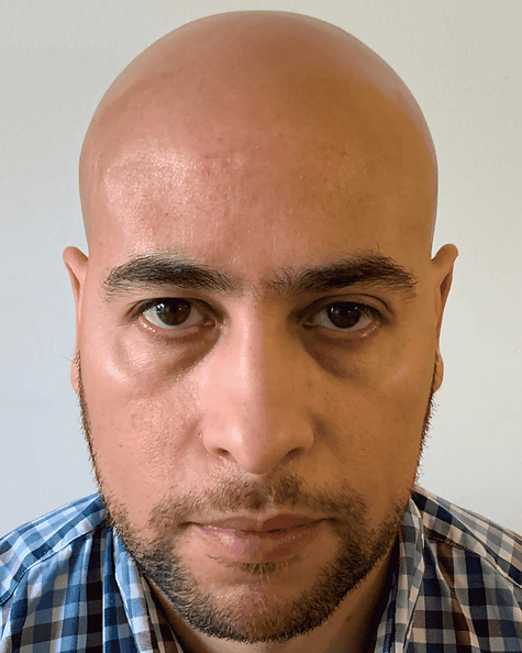 Tricopigmentation effet rasé Bruxelles