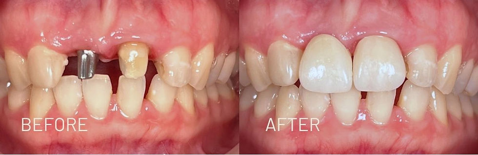 Result by Dentiq Studio - Before after dental implants