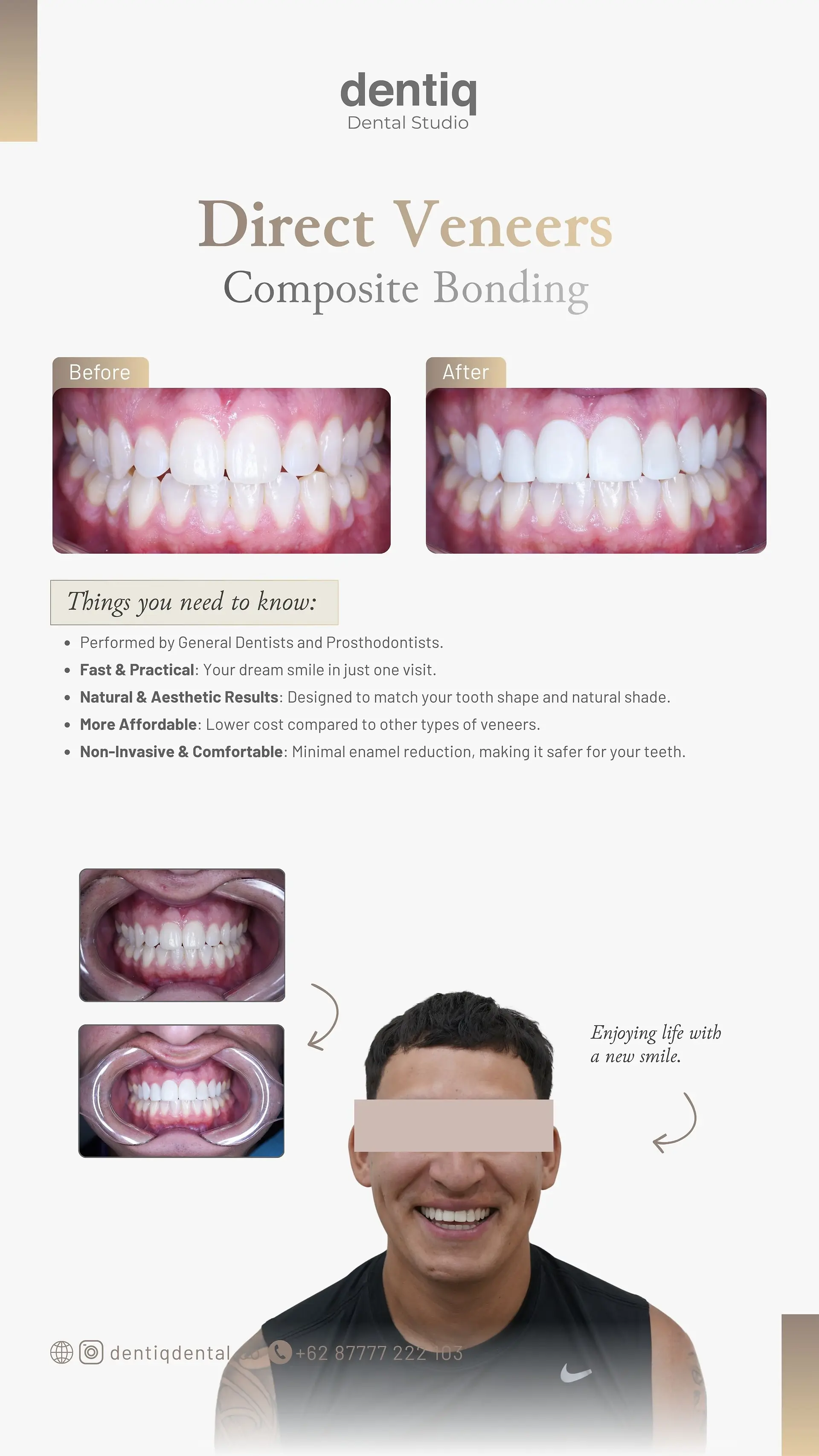 Real patient Composite Veneers in Canggu Bali | Dentiq Dental Studio