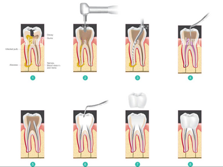 When would a dentist recommend Root Canal Treatment?