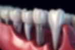 dental-implantation-teeth-with-implant-screw-3d-illustratio.jpg