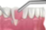 gum-grafts.jpg
