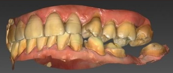 Slide fra indlægget: 3D-scanning af det slidte tandsæt