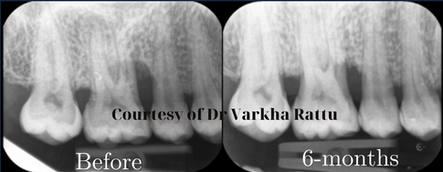 Radiographs before and 6 months after treatment