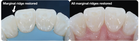 Marginal ridges restored with composite