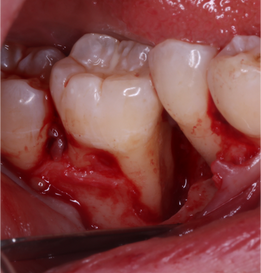 Clinical case: infrabony defect