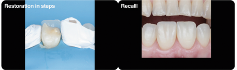 Restoration in steps and recall