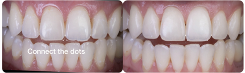 Connect the dots: before and after