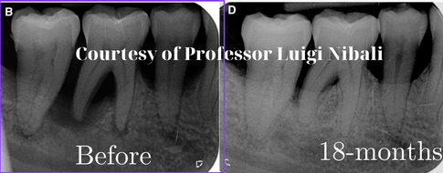 Radiographs before and 18 months after treatment
