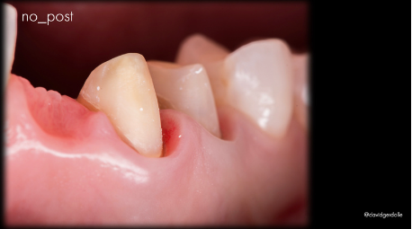 Clinical case: no-post core